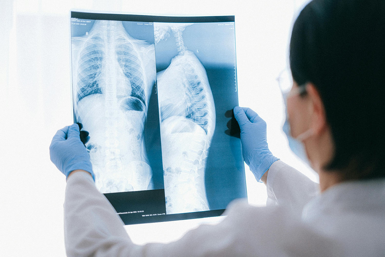 Doctor looking at an x-ray of person's lungs